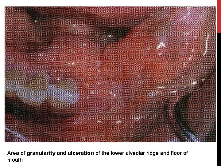 Area of granularity and ulceration of the lower alveolar ridge and floor of mouth