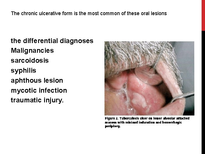 The chronic ulcerative form is the most common of these oral lesions the differential