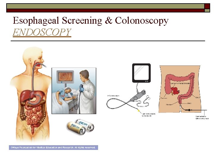Esophageal Screening & Colonoscopy ENDOSCOPY 
