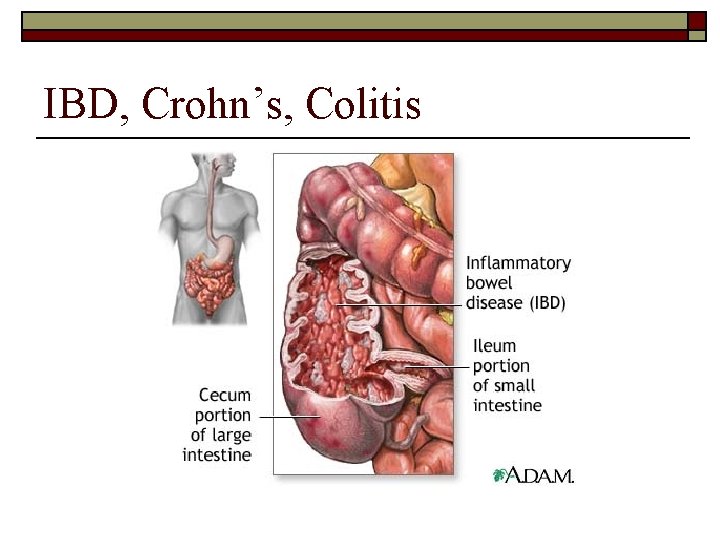 IBD, Crohn’s, Colitis 