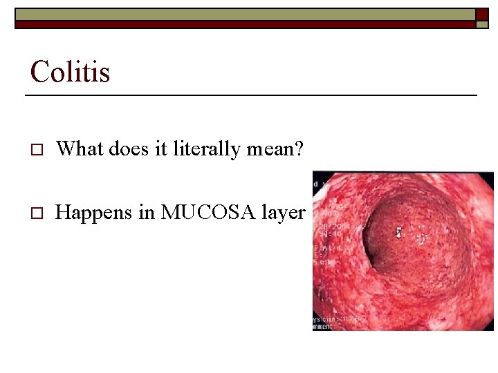 Colitis o What does it literally mean? o Happens in MUCOSA layer 