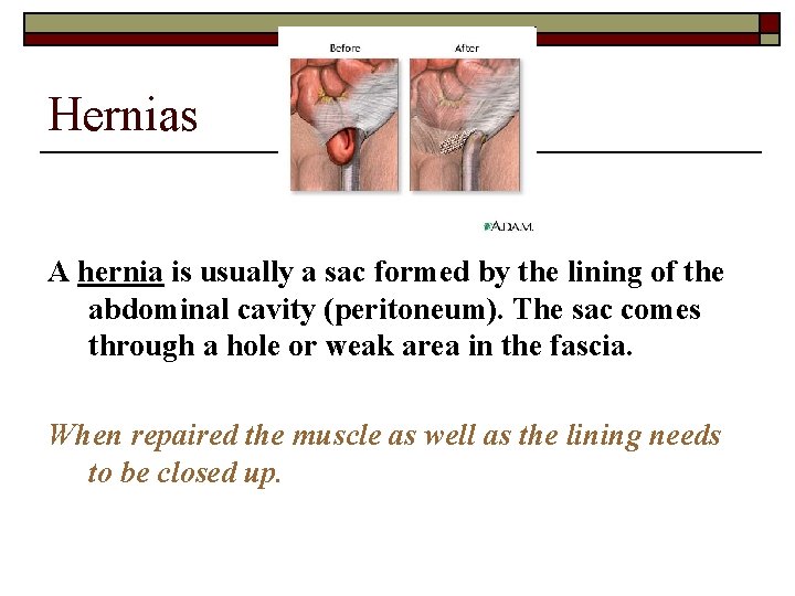 Hernias A hernia is usually a sac formed by the lining of the abdominal