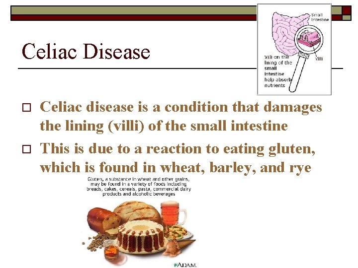 Celiac Disease o o Celiac disease is a condition that damages the lining (villi)