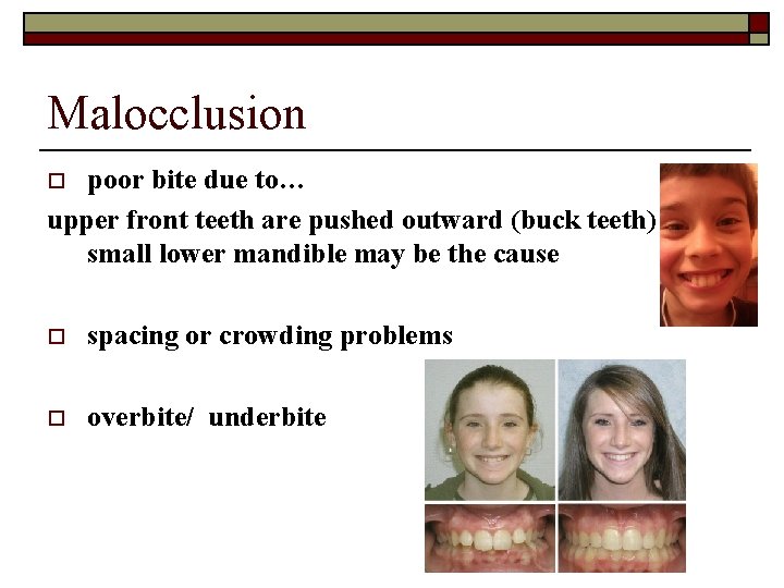 Malocclusion poor bite due to… upper front teeth are pushed outward (buck teeth) small