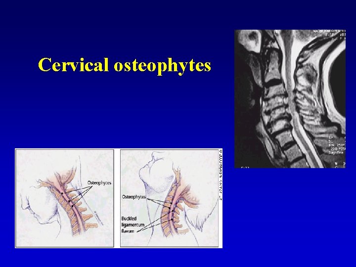 Cervical osteophytes 