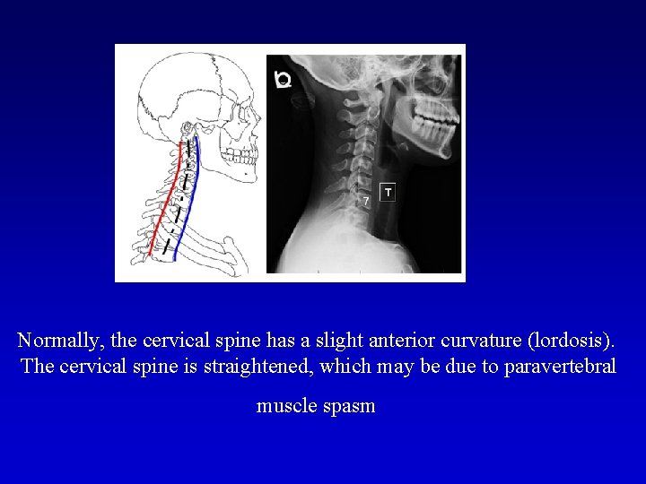 Normally, the cervical spine has a slight anterior curvature (lordosis). The cervical spine is
