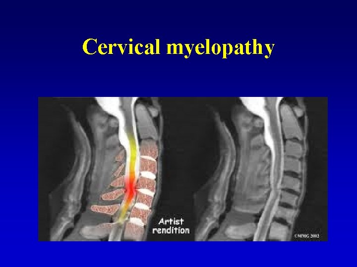 Cervical myelopathy 