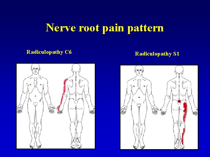 Nerve root pain pattern Radiculopathy C 6 Radiculopathy S 1 