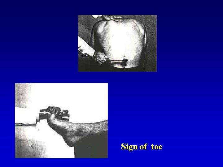 Sign of toe 