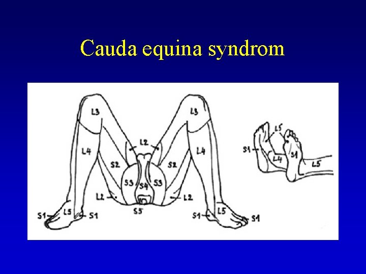 Cauda equina syndrom 