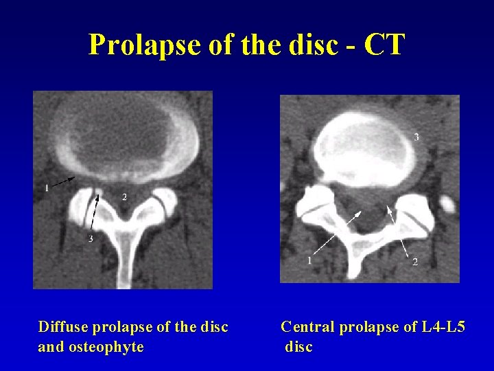 Prolapse of the disc - CT Diffuse prolapse of the disc and osteophyte Central