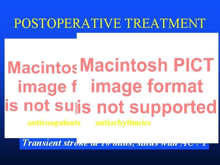 POSTOPERATIVE TREATMENT anticoagulants antiarhythmics Transient stroke at 10 mths, sinus with AC : 1