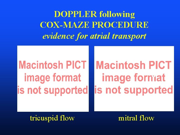 DOPPLER following COX-MAZE PROCEDURE evidence for atrial transport e a tricuspid flow mitral flow
