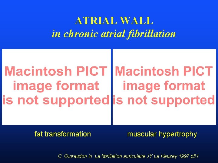 ATRIAL WALL in chronic atrial fibrillation fat transformation muscular hypertrophy C. Guiraudon in La