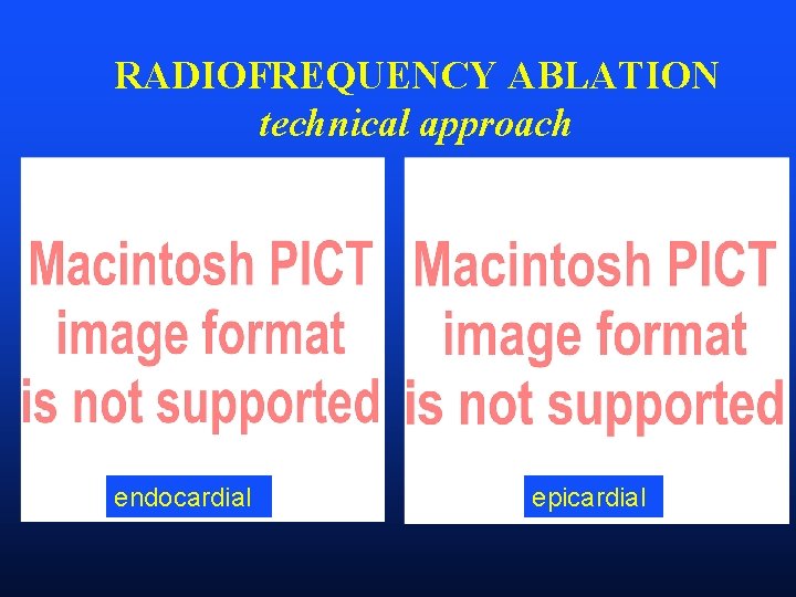 RADIOFREQUENCY ABLATION technical approach endocardial epicardial 