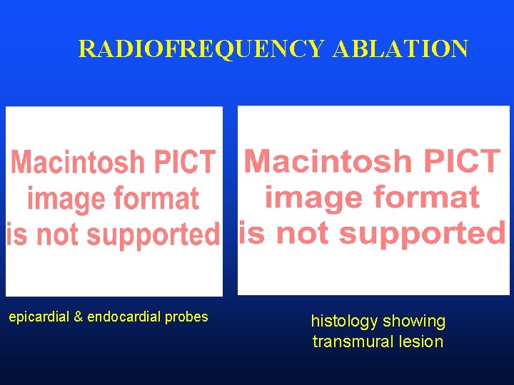 RADIOFREQUENCY ABLATION epicardial & endocardial probes histology showing transmural lesion 