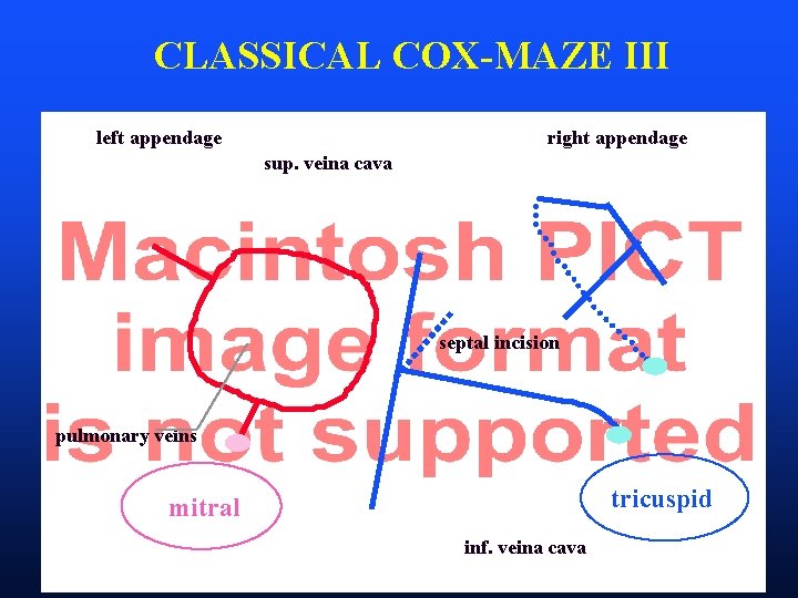CLASSICAL COX-MAZE III left appendage right appendage sup. veina cava septal incision pulmonary veins