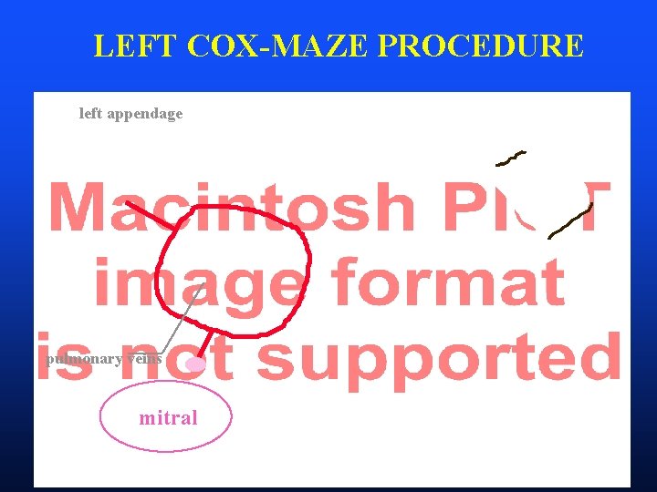 LEFT COX-MAZE PROCEDURE left appendage pulmonary veins mitral 