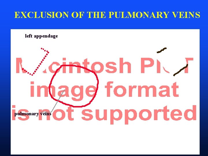 EXCLUSION OF THE PULMONARY VEINS left appendage pulmonary veins 