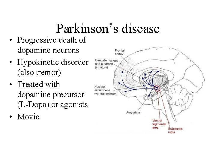 Parkinson’s disease • Progressive death of dopamine neurons • Hypokinetic disorder (also tremor) •