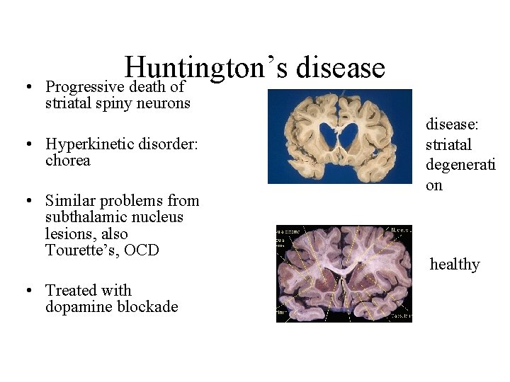  • Huntington’s disease Progressive death of striatal spiny neurons • Hyperkinetic disorder: chorea