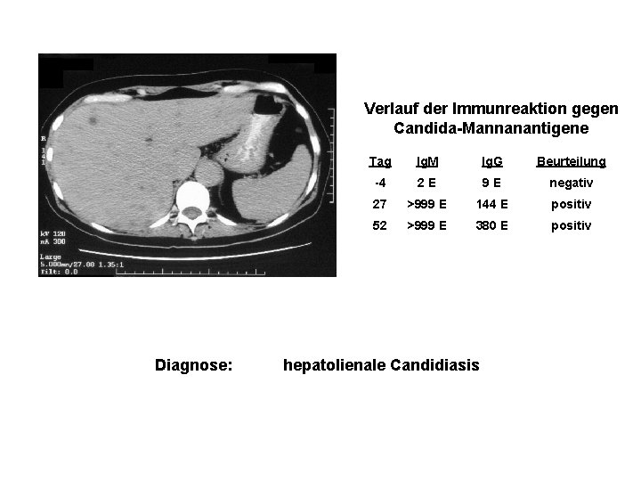 Verlauf der Immunreaktion gegen Candida-Mannanantigene Diagnose: Tag Ig. M Ig. G Beurteilung -4 2