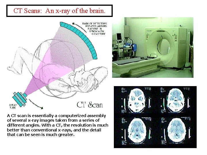 CT Scans: An x-ray of the brain. A CT scan is essentially a computerized