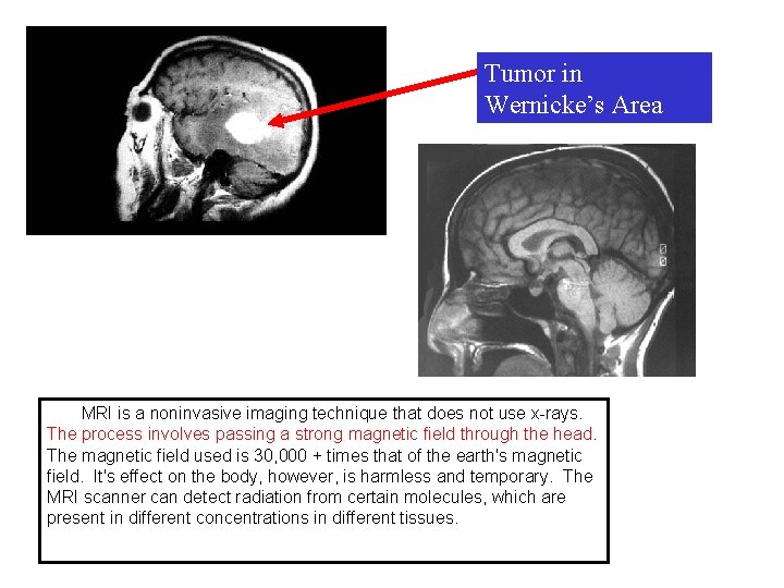 Tumor in Wernicke’s Area MRI is a noninvasive imaging technique that does not use