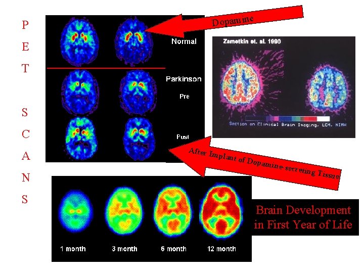 Dopamine P E T S C A N S After I mplant of Dopa