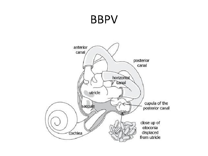 BBPV 