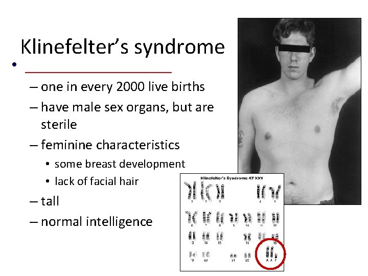 Klinefelter’s syndrome • _________ – one in every 2000 live births – have male