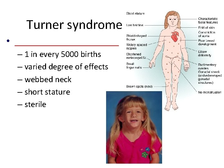 Turner syndrome • ___________ – 1 in every 5000 births – varied degree of