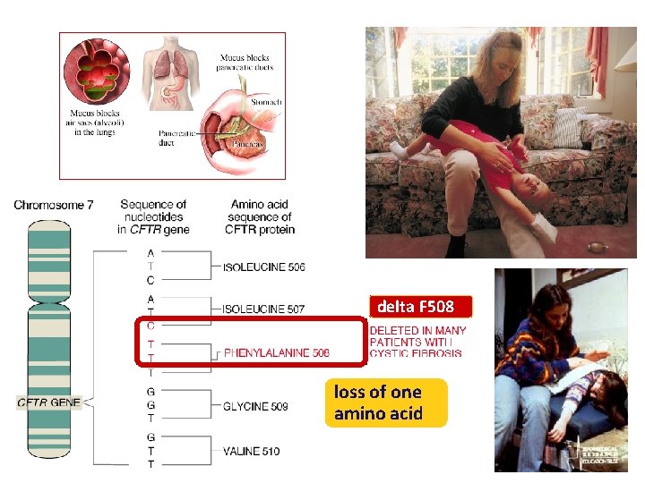 delta F 508 loss of one amino acid 