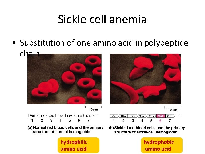 Sickle cell anemia • Substitution of one amino acid in polypeptide chain hydrophilic amino