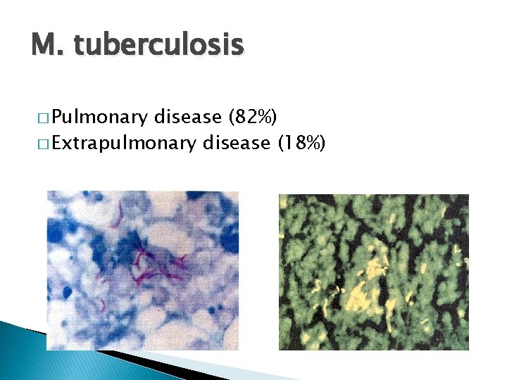 M. tuberculosis � Pulmonary disease (82%) � Extrapulmonary disease (18%) 