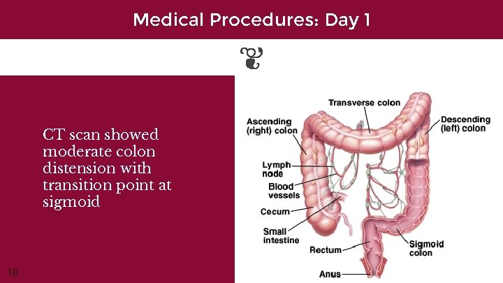 Medical Procedures: Day 1 CT scan showed moderate colon distension with transition point at