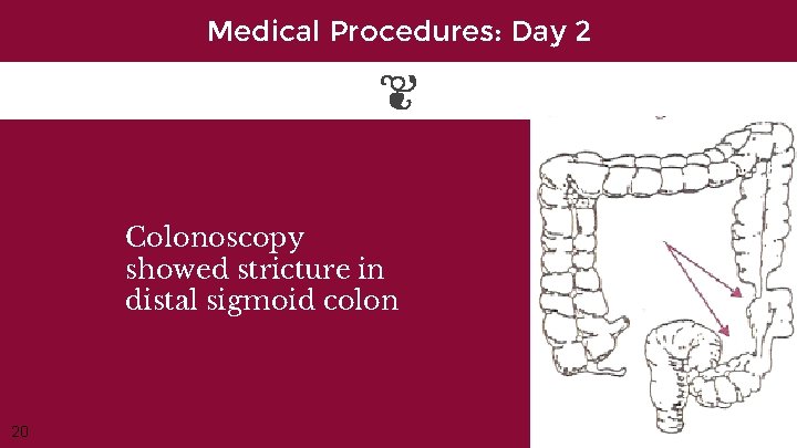 Medical Procedures: Day 2 Colonoscopy showed stricture in distal sigmoid colon 20 