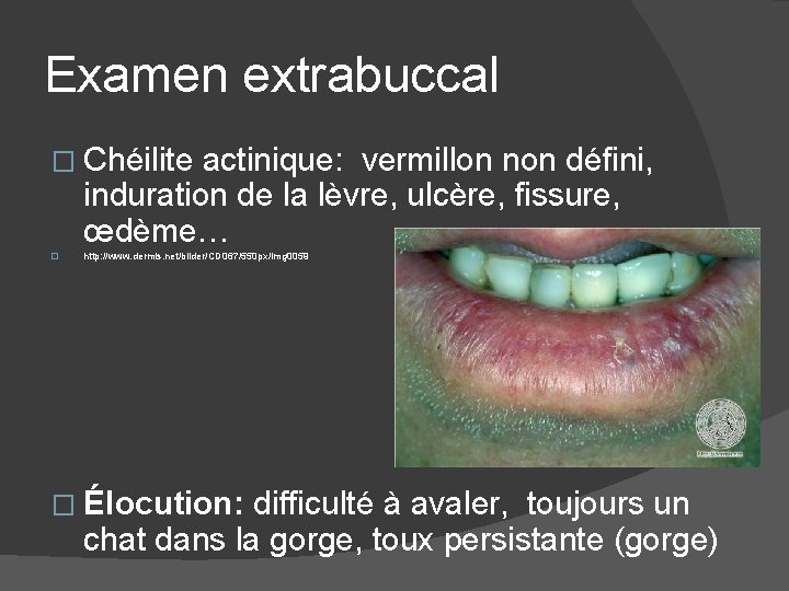 Examen extrabuccal � Chéilite actinique: vermillon non défini, induration de la lèvre, ulcère, fissure,