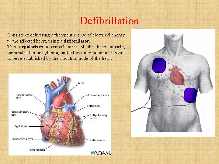 Defibrillation Consists of delivering a therapeutic dose of electrical energy to the affected heart,