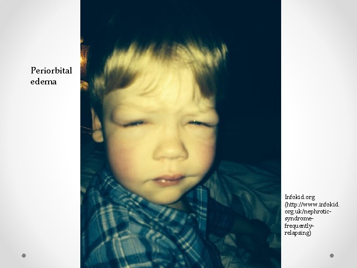 Periorbital edema Infokid. org (http: //www. infokid. org. uk/nephroticsyndromefrequentlyrelapsing) 