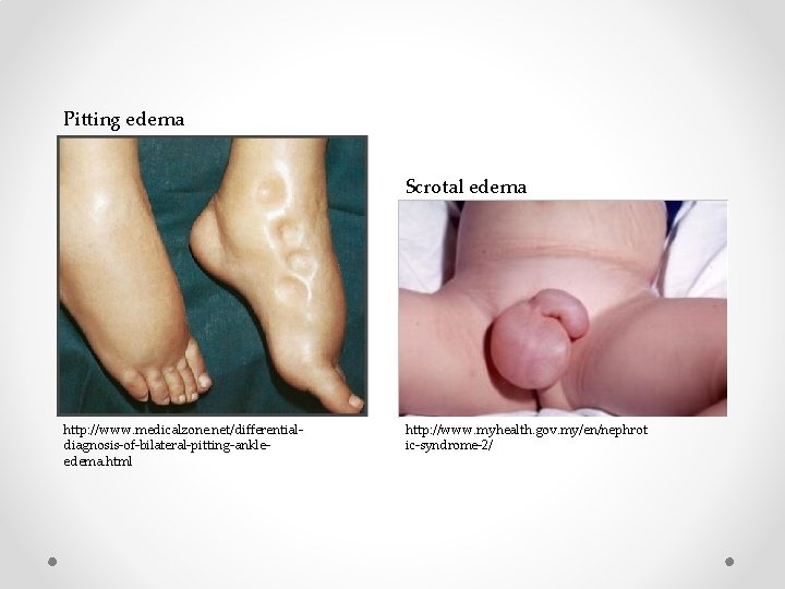 Pitting edema Scrotal edema http: //www. medicalzone. net/differentialdiagnosis-of-bilateral-pitting-ankleedema. html http: //www. myhealth. gov. my/en/nephrot