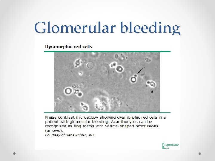 Glomerular bleeding 