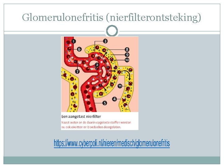 Glomerulonefritis (nierfilterontsteking) 