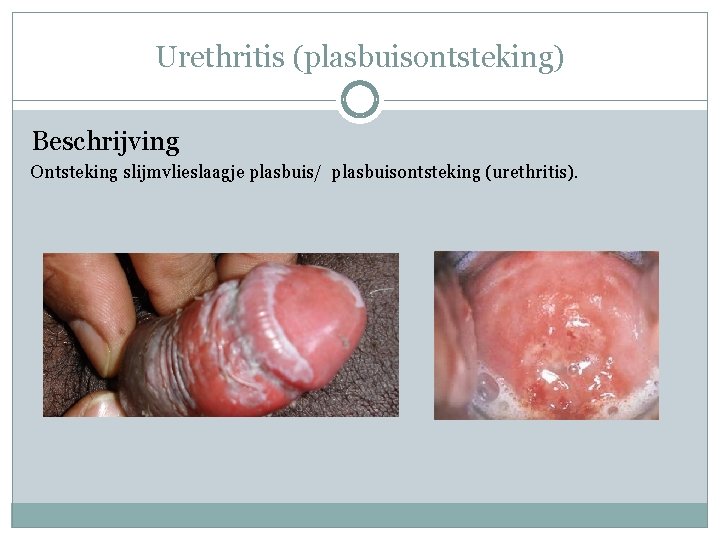 Urethritis (plasbuisontsteking) Beschrijving Ontsteking slijmvlieslaagje plasbuis/ plasbuisontsteking (urethritis). 