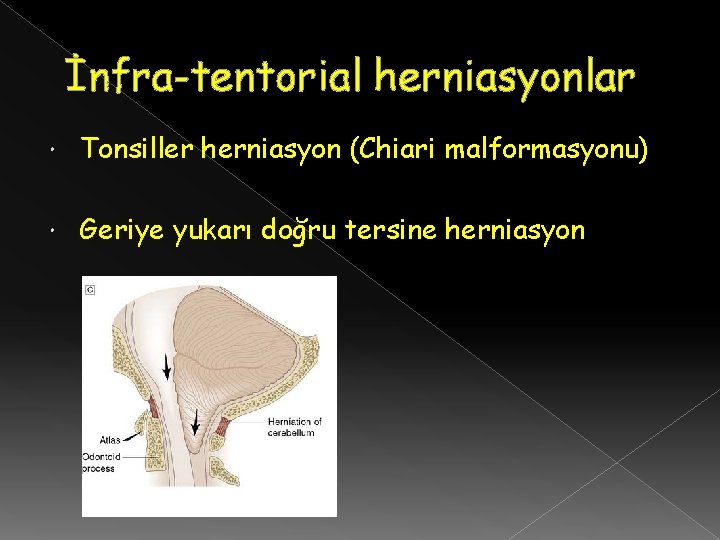 İnfra-tentorial herniasyonlar Tonsiller herniasyon (Chiari malformasyonu) Geriye yukarı doğru tersine herniasyon 