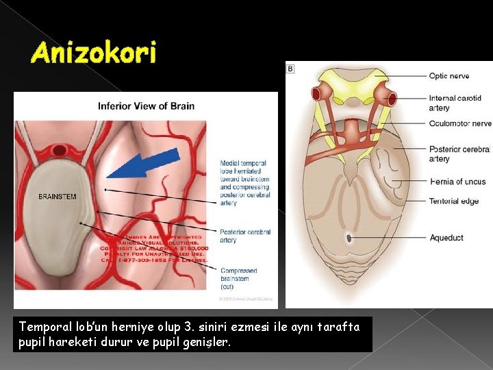 Anizokori Temporal lob’un herniye olup 3. siniri ezmesi ile aynı tarafta pupil hareketi durur