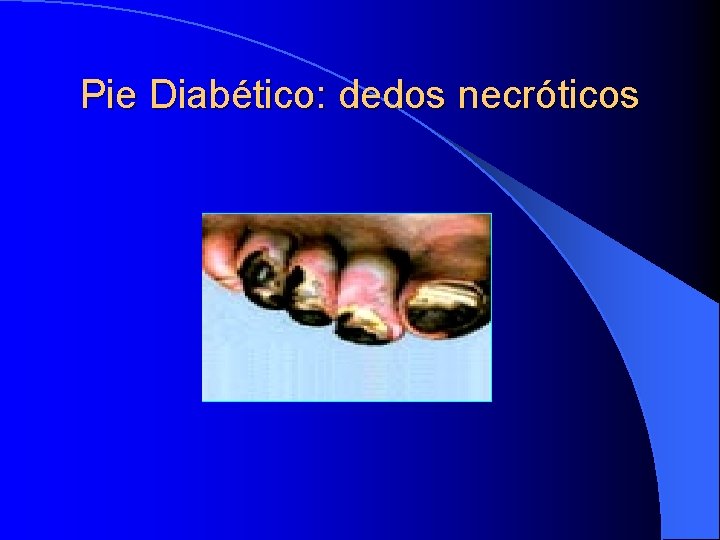 Pie Diabético: dedos necróticos 