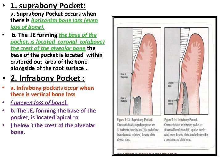  • 1. suprabony Pocket: a. Suprabony Pocket occurs when there is horizontal bone