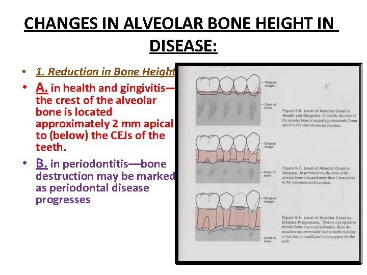CHANGES IN ALVEOLAR BONE HEIGHT IN DISEASE: • 1. Reduction in Bone Height •