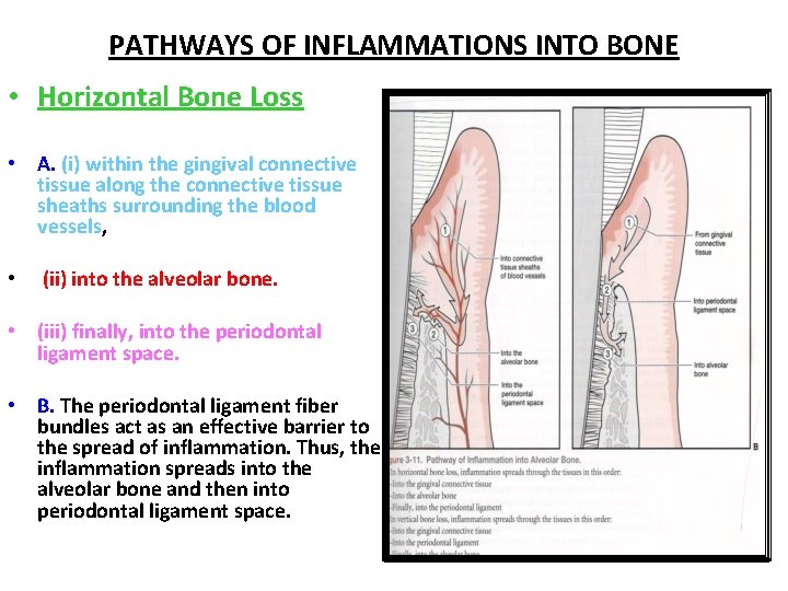 PATHWAYS OF INFLAMMATIONS INTO BONE • Horizontal Bone Loss • A. (i) within the